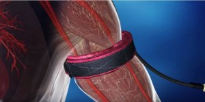 Pression sanguine du bras.