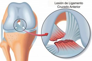 Lésions des ligaments croisés.